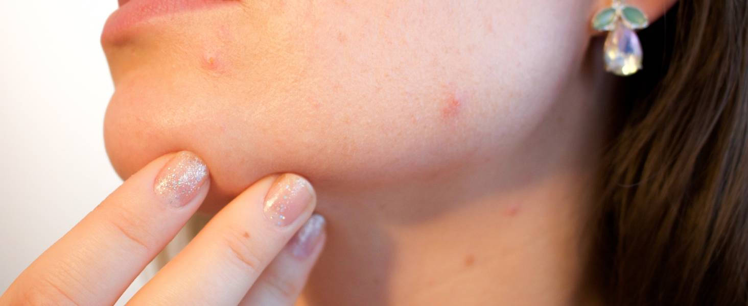 Το ταξίδι προς ένα acne free πρόσωπο